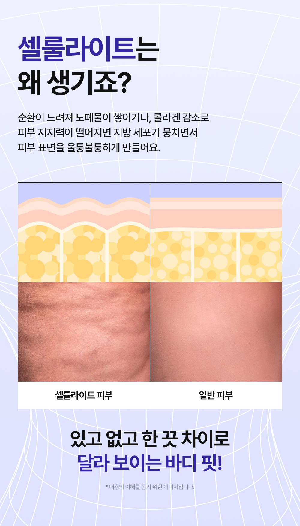셀룰라이트는 왜 생기죠? 순환이 느려져 노폐물이 쌓이거나, 콜라겐 감소로 피부 지지력이 떨어지면 지방 세포가 뭉치면서 피부 표면을 울퉁불퉁하게 만들어요.