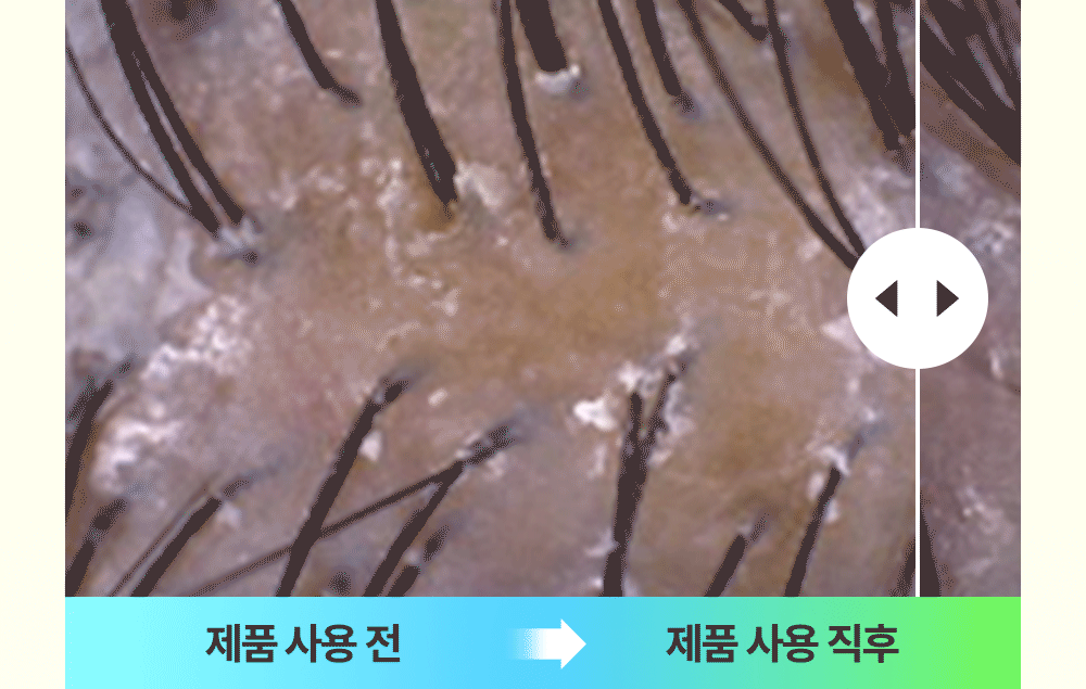 제품 사용 전 직후 두피 비교