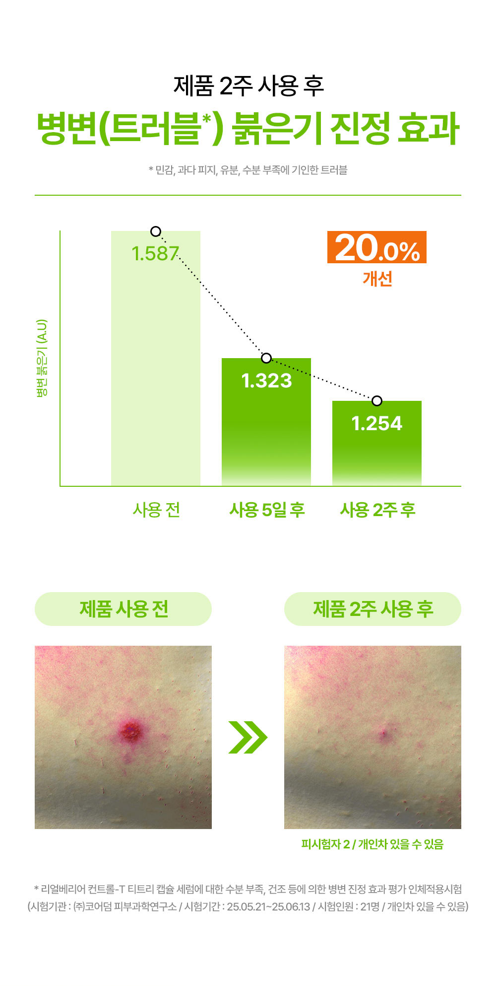 제품 2주 사용 후 병변 붉은기 진정 효과