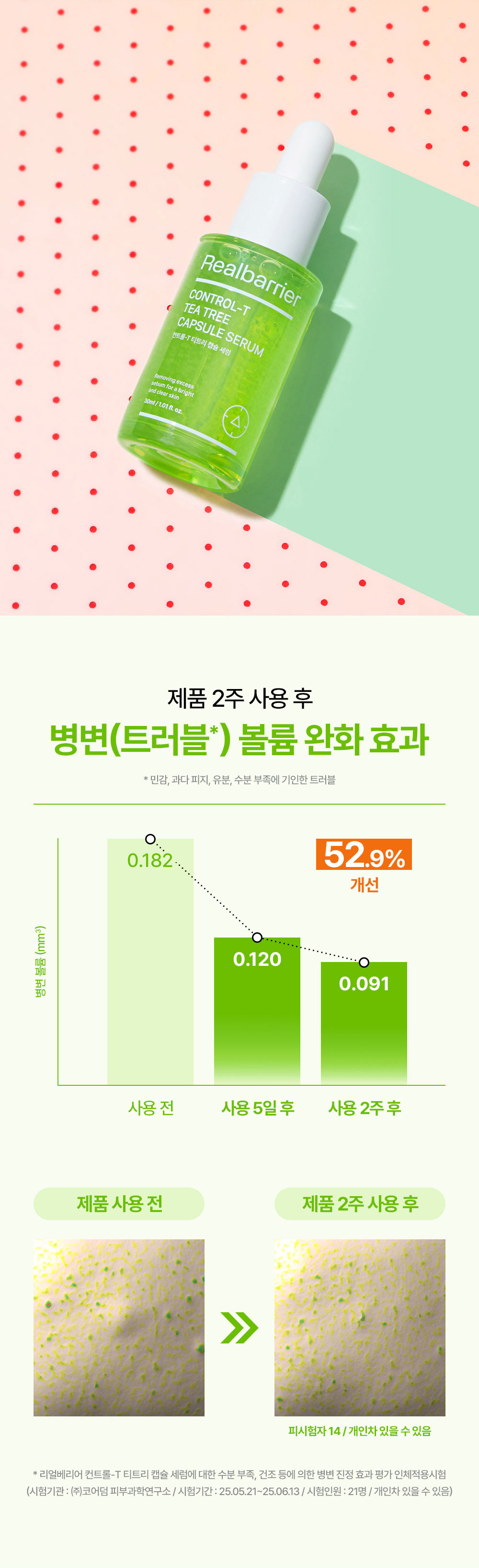 제품 2주 사용 후 병변 볼륨 완화 효과