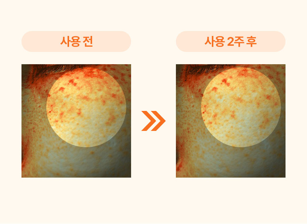 사용 전과 사용 2주 후 과색소 수 비교 이미지