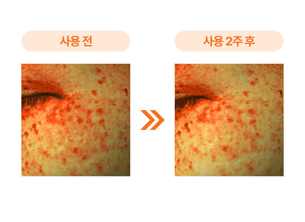 사용 전과 사용 2주 후 큰 잡티 면적 비교 이미지